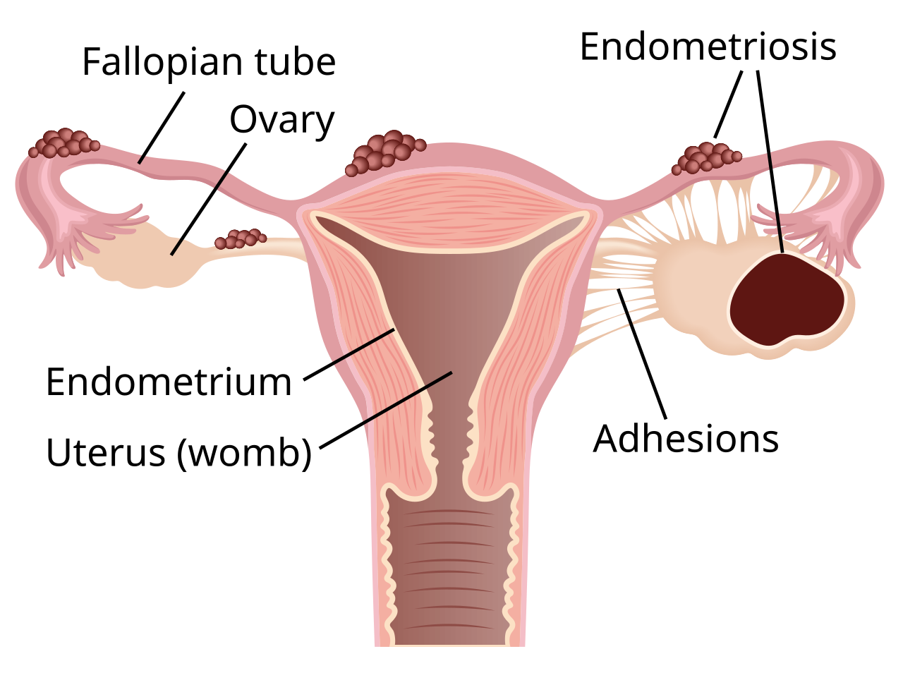 Endometriosis Treatment in Dubai