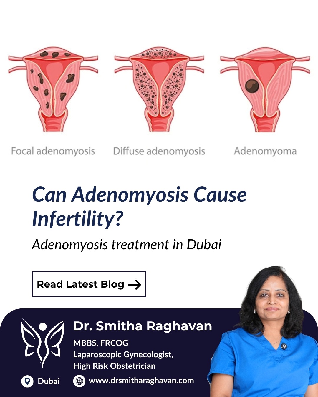 Adenomyosis Treatment in Dubai | Dr. Smitha Raghavan